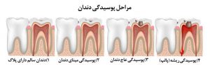 مراحل پوسیدگی دندان